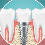 あなたはあなたの歯科用合金をどれくらいよく知っていますか？