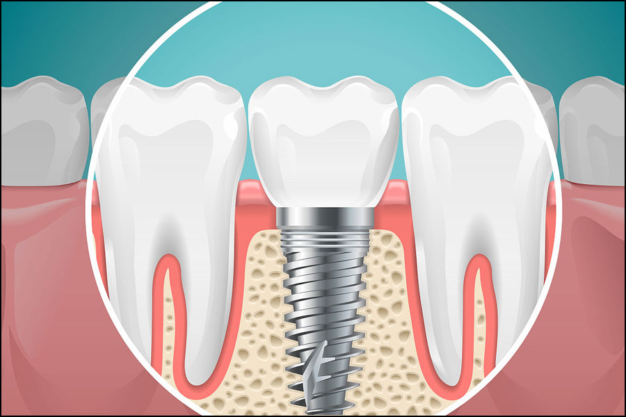あなたはあなたの歯科用合金をどれくらいよく知っていますか？